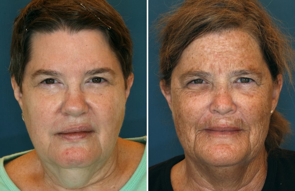 Twins Sun Damage Study between twins on sun exposure